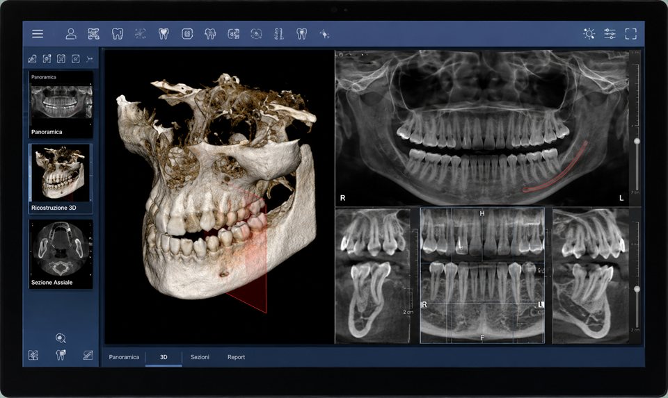 3D dental imaging software showing a panoramic X-ray, a 3D reconstruction and cross-sections